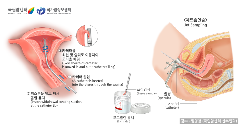 제트흡인술